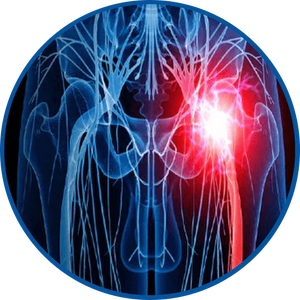 Sciatica Pain